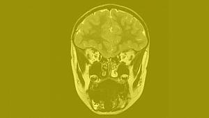 Kallmann Sendromu Vakfı kuruluşuna onay